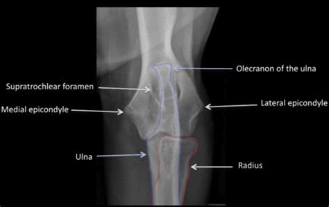 Elbow Dysplasia Flashcards | Quizlet