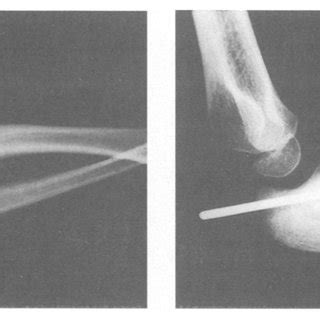 -a) Congenital proximal radioulnar synostosis. Preoperative x-ray, b)... | Download Scientific ...