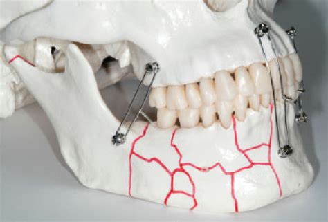 Orif Mandibular Fracture