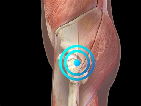 Greater Trochanteric Pain Syndrome – EMS DolorClast®