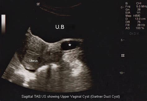 Inclusion Cyst Gartner Duct Cyst S