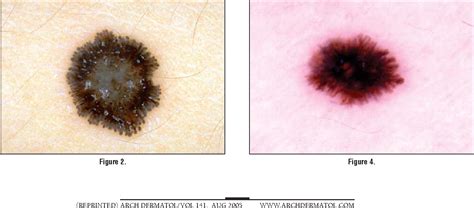 Figure 1 from Dermoscopy of pigmented Spitz and Reed nevi: the starburst pattern. | Semantic Scholar