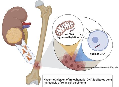 Hypermethylation of mitochondrial DNA facilitates bone metastasis of ...