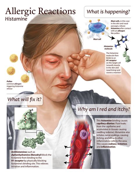 Histamine Allergy