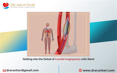 Carotid Angioplasty with Stent Details - Dr Arun Hari