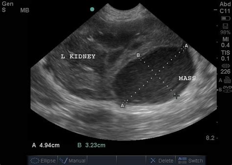 Renal Abscess in a 7yo Unstable Diabetic Weimeraner, Klebsiella cultured after ultrasound-guided ...