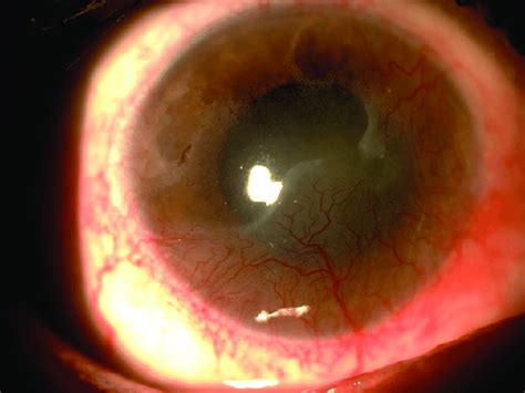 Conjunctivalization with deep and superficial corneal vascularization ...