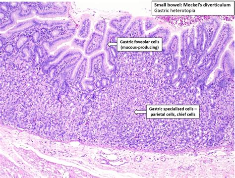 Intestine – Meckel's Diverticulum – NUS Pathweb :: NUS Pathweb