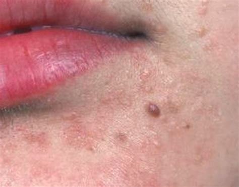 Flat Warts on Face - Pictures, Treatment, Causes, Removal