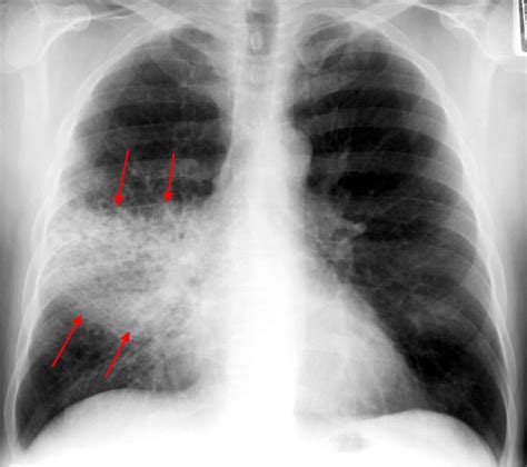 How to Read a Chest Xray II : Pneumonia – Medchrome