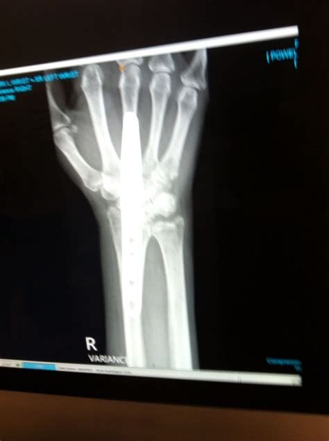 My wrist after fusion. There is also screws in there from partial fusion previously | Wrist ...