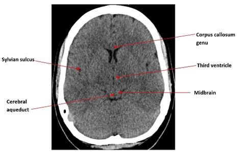 Ct Brain Anatomy - Anatomy Reading Source