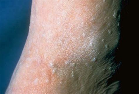 stucco keratosis - pictures, photos