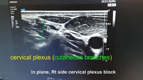 Rt side superficial cervical plexus block | United States of America ...