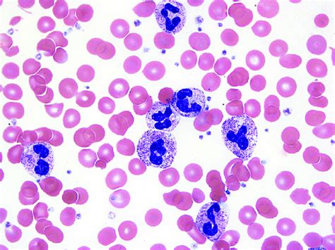 Neutrophils showing toxic granulation, Döhle bodies and cytoplasmic ...