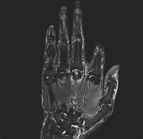 Sagittal Band Mri Hand