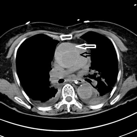 A Non Contrast Ct Brain In Case Showed A Right Posterior Fossa Edh | My ...