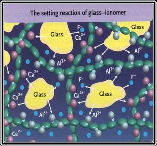 GLASS IONOMER CEMENT - Focus Dentistry