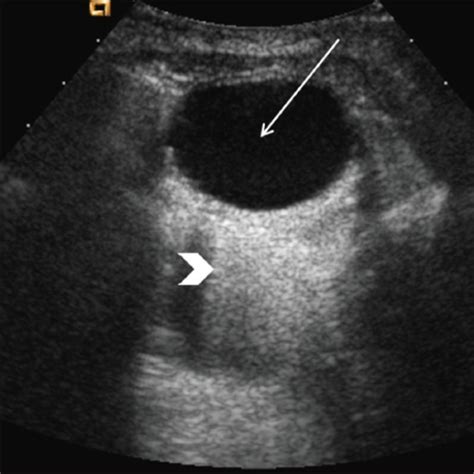 Simple ovarian cyst. Longitudinal image through the pel | Open-i