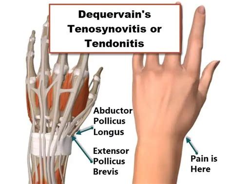 Wrist Tendon Anatomy