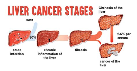 Cancer of the liver Hepatocellular Carcinoma (HCC) – Dr Faisal Dar