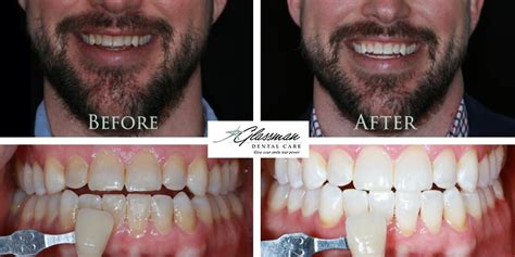 Teeth Whitening Gallery | Glassman Dental Care | UWS | NYC