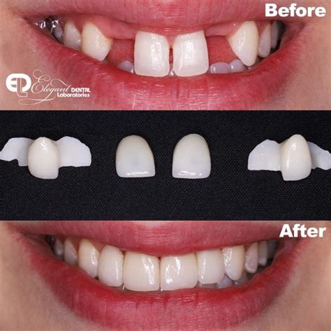 A before and after with our Emax Crowns | Elegant Lab