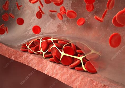 Thrombosed blood vessel, artwork - Stock Image - C013/4649 - Science Photo Library