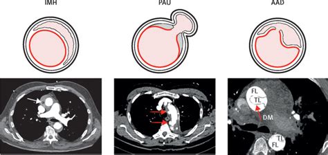 Acute aortic dissection - The Lancet