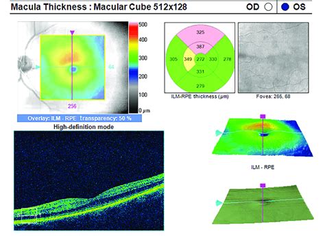 OCT. Increased thickness of the inner layers of the involved retina ...