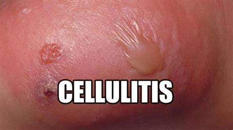 Cellulitis? What is it? Treatments, Causes and Symptoms! - YouTube