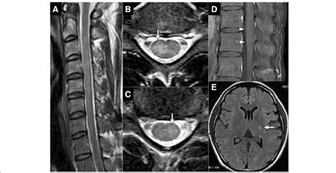 Differential Diagnosis Of T2 Hyperintense Spinal Cord Lesions - mapametawan