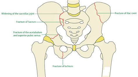 Pelvic Bone Fracture