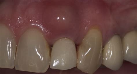 What is dental granuloma? | News | Dentagama