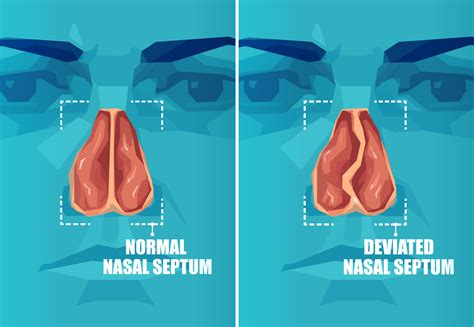 Nasal Septum Deviation – Symptoms, Causes & Treatment