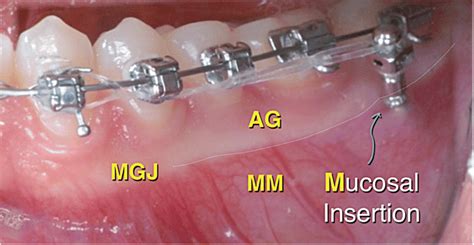 The mucogingival junction (MGJ) of the mandibular left buccal segment ...