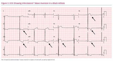 ECG Showing Inferolateral T Wave Inversion in a Black Athlete ...