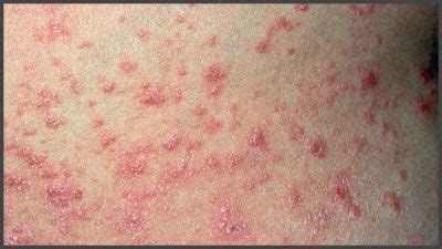 Pictures of psoriasis rash | Psoriasis expert