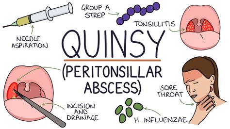 Peritonsillar Abscess Picture