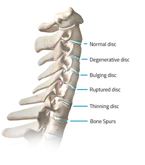 Degenerative Disc Disease & Herniated Discs in Neck – m6disc.com