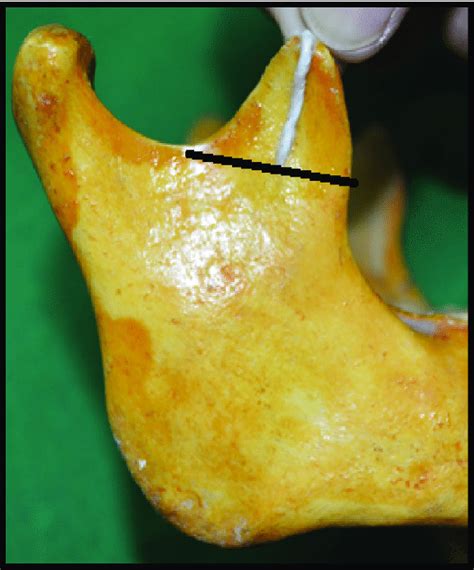 Illustration showing measurement of height of coronoid process at its... | Download Scientific ...