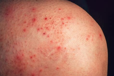 Red Spots on Legs, Feet, Dots, Patches, Not Itchy, Pictures, Causes, Treatment & Home Remedies