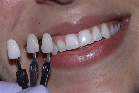 How Much Are Veneers Ontario at Margaret Glover blog