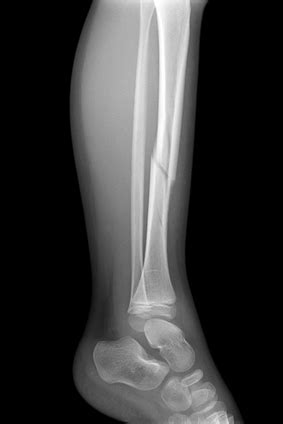 X-ray of broken leg - OKC Video Production and Podcast Studios