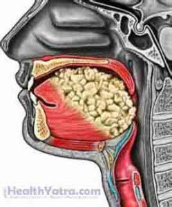 Best Cost Glossectomy Surgery, Treatment Hospital in India