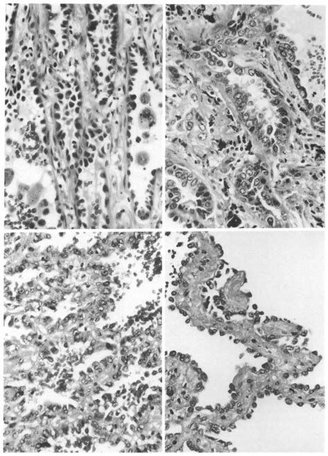 (upper, left). Histology of case 11. A. In most parts of the lesion,... | Download Scientific ...