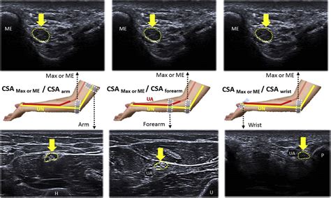 Ultrasound Parameters Other Than The Direct Measurement Of Ulnar Nerve ...