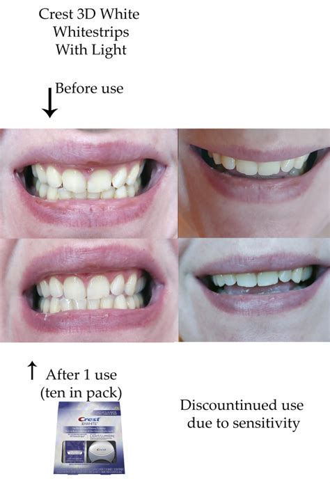 Crest 3D White Whitestrips with Light reviews in Teeth Whitening - ChickAdvisor