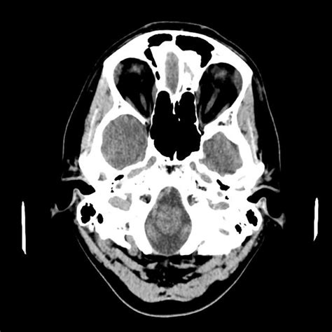 Cavum velum interpositum cyst | Radiology Case | Radiopaedia.org