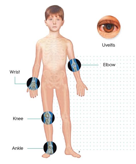 Juvenile Idiopathic Arthritis – Medinformer